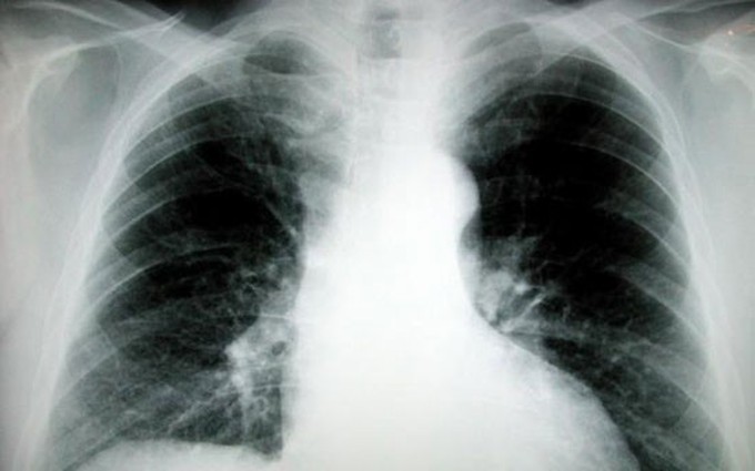 Ung thư phổi di căn xương là gì, dấu hiệu, biến chứng và cách chẩn đoán