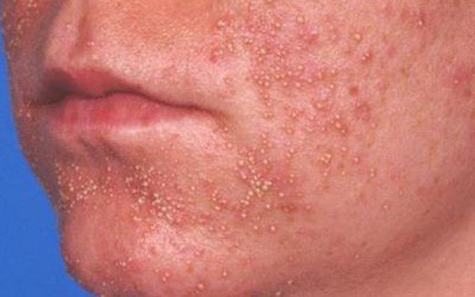 Tìm hiểu về dấu hiệu nhận biết viêm nang lông ở mặt