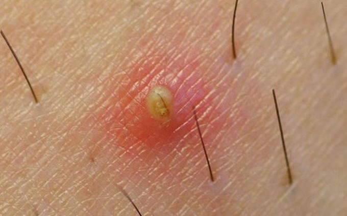 Các dấu hiệu viêm nang lông thường gặp ở lưng và tay, chân