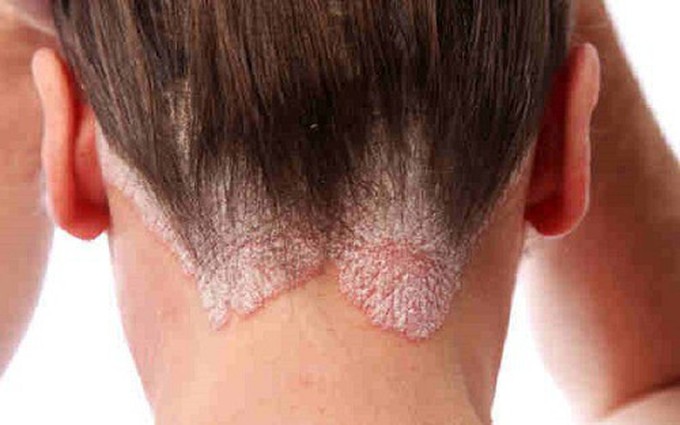 Những dấu hiệu nhận biết viêm nang lông ở da đầu