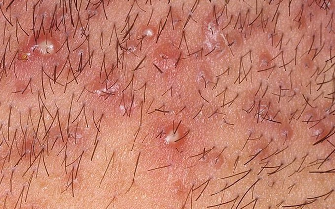Những dấu hiệu nhận biết viêm nang lông vùng kín