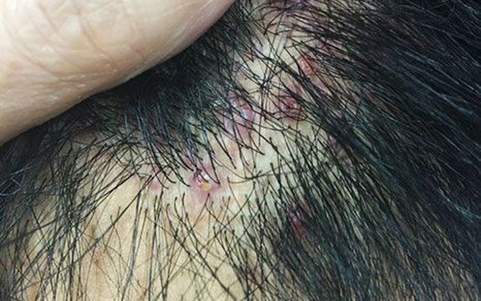 Mức độ nguy hiểm của biến chứng sẹo lồi do viêm nang lông và cách xử lý
