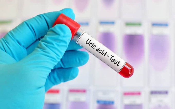 Acid uric: Mối liên quan giữa acid uric và bệnh gout, khi nào cần xét nghiệm chỉ số này?