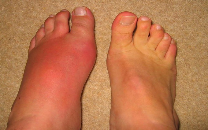 Bệnh gout: dấu hiệu, nguyên nhân, điều trị và phương pháp phòng ngừa