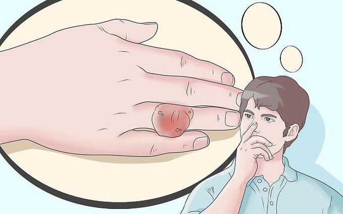Các tiêu chí chẩn đoán gout: Có phải cứ tăng acid uric máu là bị bệnh gout?