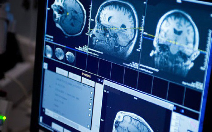 Một số dấu hiệu ung thư thanh quản di căn não