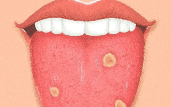 Tự kiểm tra lưỡi tại nhà để phát hiện 8 căn bệnh này