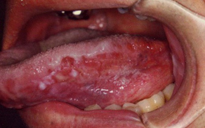 3 điều cần biết về bệnh ung thư lưỡi di căn