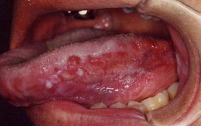 Ung thư lưỡi và những yếu tố làm tăng nguy cơ mắc bệnh