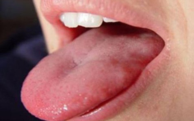 Các phương pháp điều trị ung thư lưỡi giai đoạn cuối