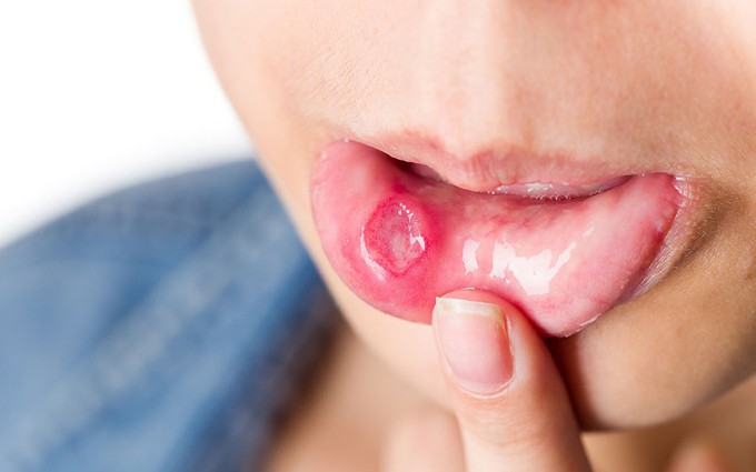 Loét miệng lâu ngày- dấu hiệu dễ bị bỏ qua của ung thư lưỡi 