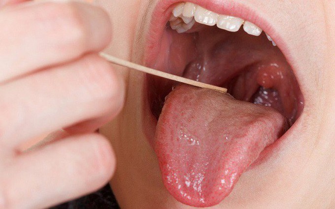 Khi nào chỉ định tái tạo lưỡi cho bệnh nhân ung thư lưỡi?