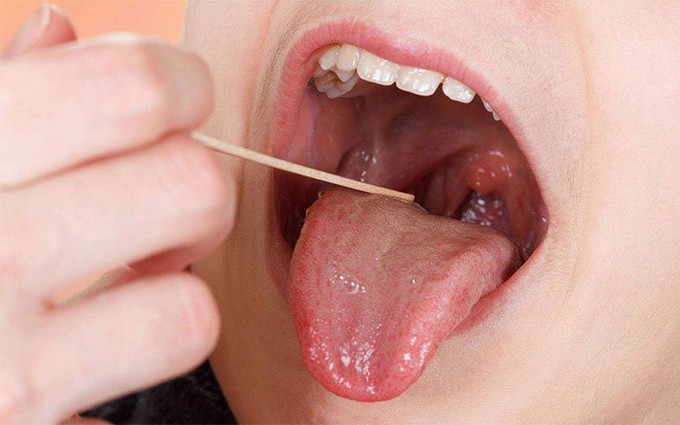 6 nguyên tắc chăm sóc bệnh nhân ung thư lưỡi