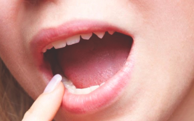 2 sai lầm thường gặp khi vệ sinh răng miệng cho bệnh nhân ung thư lưỡi 