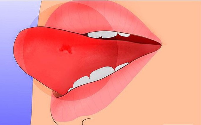 Ung thư lưỡi giai đoạn cuối sống được bao lâu?