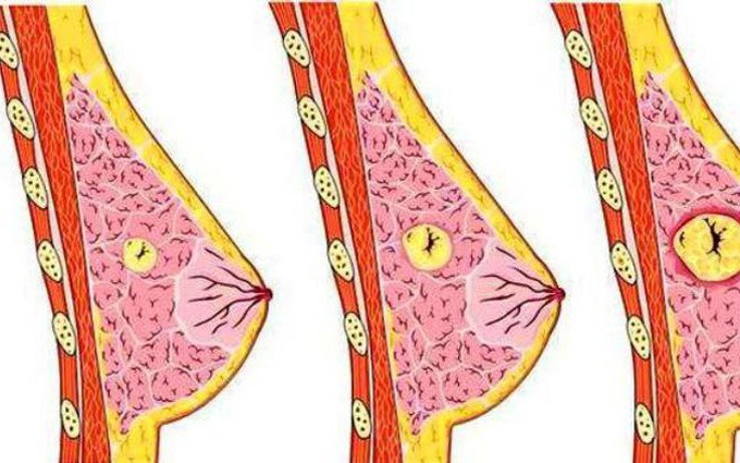 Loại bỏ u vú không cần phẫu thuật – An toàn, hiệu quả, hạn chế tổn thương