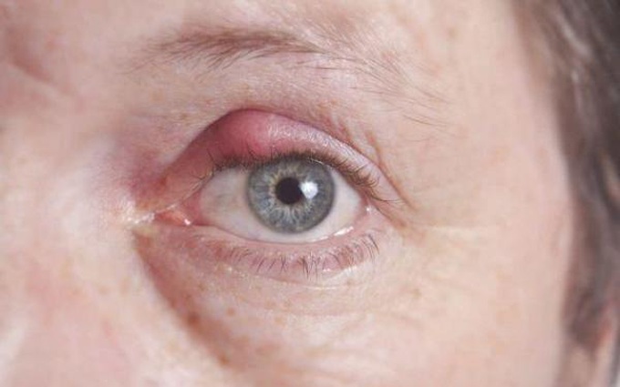 Bệnh lẹo mắt là một bệnh lý rất phổ biến. Hãy xem hình ảnh để tìm hiểu thêm về triệu chứng và cách phòng chống bệnh lẹo mắt.