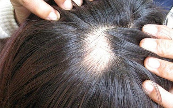 Hói đầu Nguyên nhân dấu hiệu và cách phòng ngừa hói đầu