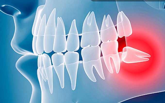 Răng khôn là răng gì? Những điều cần biết về việc nhổ răng khôn