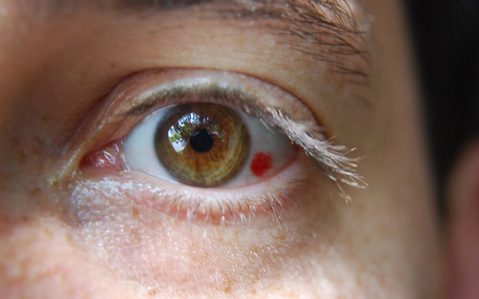Vỡ mạch máu trong mắt là gì? Tìm hiểu chung về bệnh vỡ mạch máu trong mắt