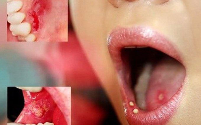5 dấu hiệu ung thư miệng và cách điều trị