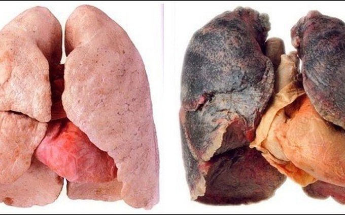 Tổng hợp các nguyên nhân gây ung thư phổi