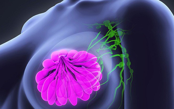 Các giai đoạn phát triển của ung thư vú