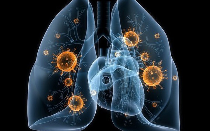 Cảnh báo: 4 nhóm người có nguy cơ mắc ung thư phổi!