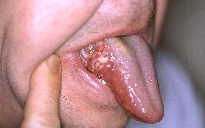 Nhận biết những dấu hiệu điển hình của bệnh ung thư lưỡi