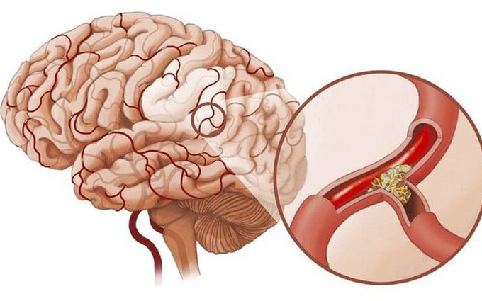 Có bao nhiêu dạng đột quỵ, dạng nào có nguy cơ tử vong cao nhất?