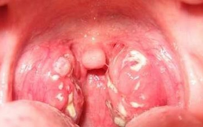 Dấu hiệu ung thư vòm họng sớm nhất và cách phòng ngừa bệnh hiệu quả