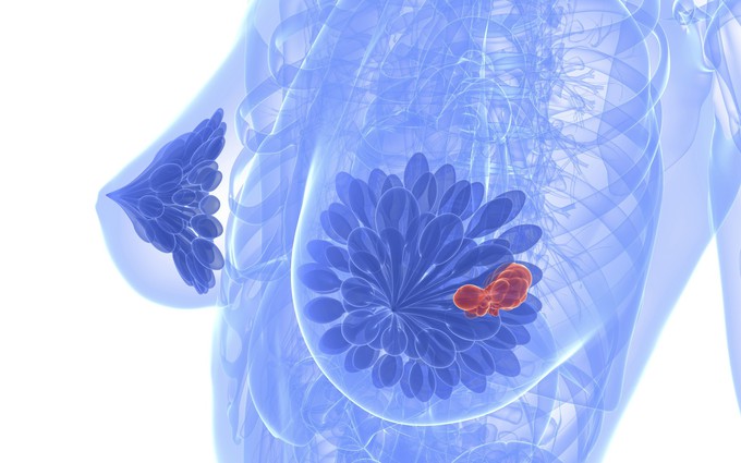 Ung thư vú và cách phục hồi chức năng sau điều trị giúp người bệnh khỏe nhanh hơn