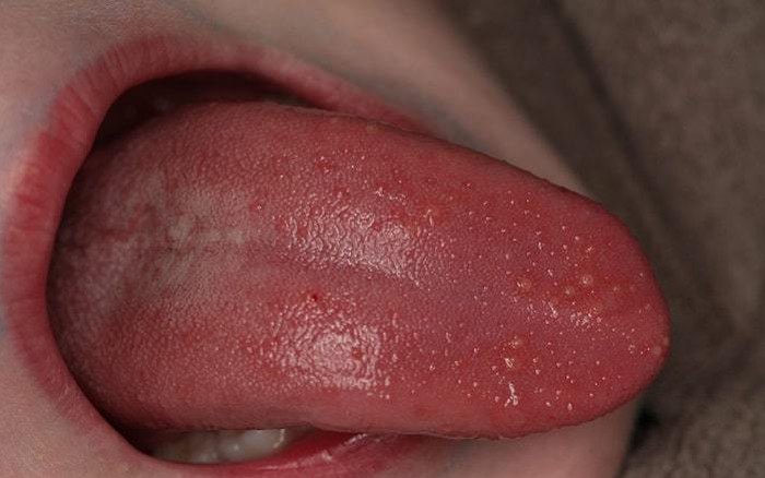 Lưỡi nổi hạt không đau là bệnh gì?